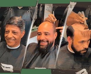 Antes e depois de clientes reais com prótese capilar aplicada por Bruno Soares