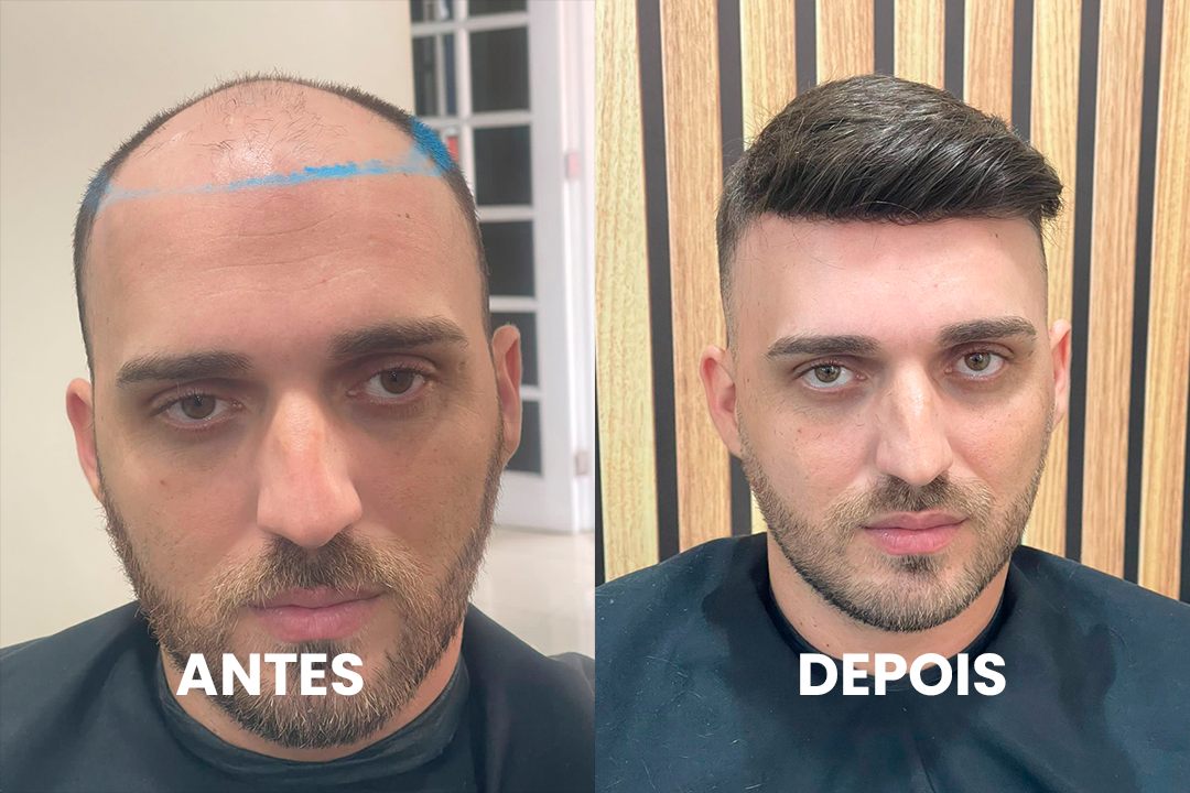 Antes e depois de cliente real com prótese capilar por Bruno Soares