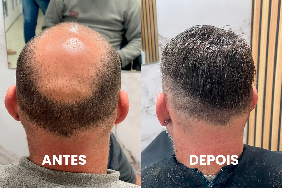 Antes e depois de cliente real com prótese capilar por Bruno Soares