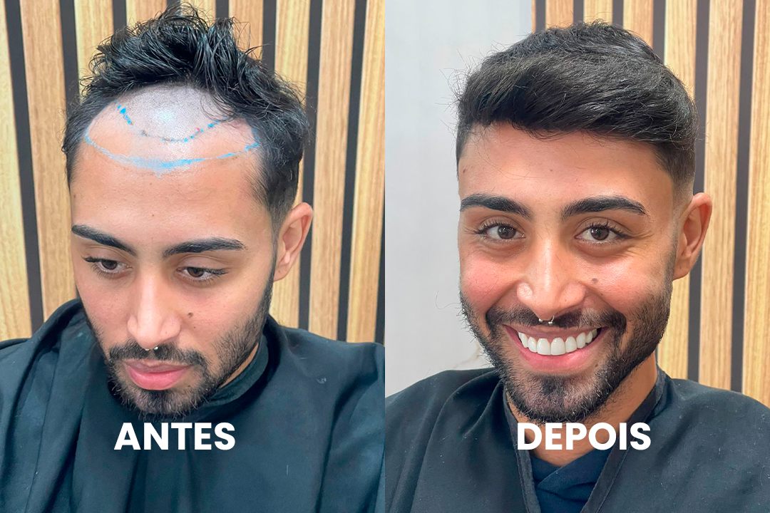 Antes e depois de cliente real com prótese capilar por Bruno Soares