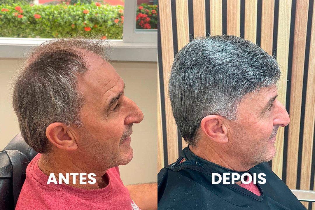 Antes e depois de cliente real com prótese capilar por Bruno Soares