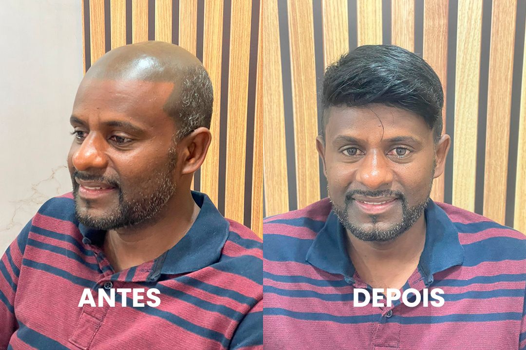 Antes e depois de cliente real com prótese capilar por Bruno Soares